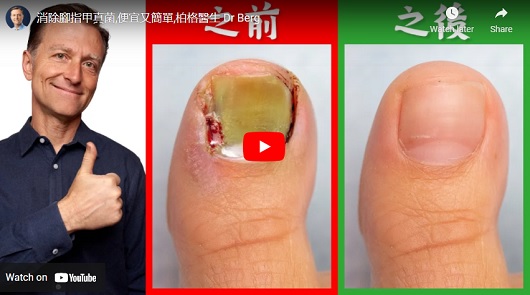 消除腳指甲真菌，便宜又簡單！少於2元美金！